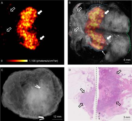 Combined Optical and Molecular Imaging Could Guide Breast-Conserving Surgery