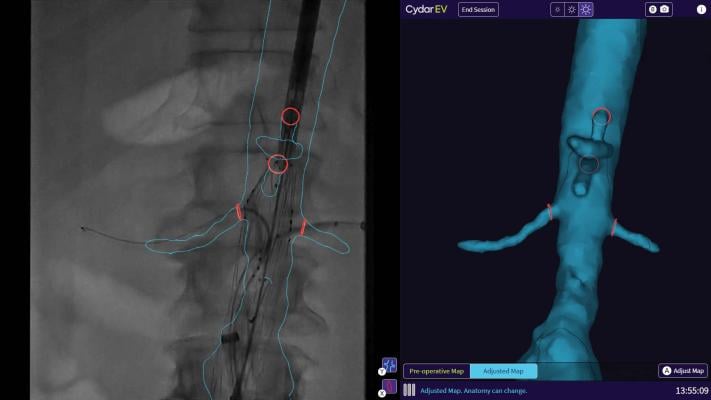Cydar EV Maps assists in the planning, real-time guidance, and post-procedure review of endovascular surgery.