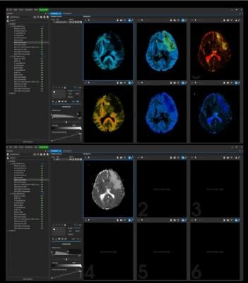 Random Walk Imaging AB (RWI), a company developing novel software solutions for diffusion magnetic resonance imaging (MRI), announced the launch of its first commercial software product for clinical researchers and radiologists.