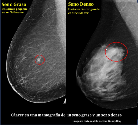 Spanish, breast health, breast density, DenseBreast-info.org