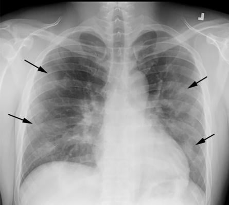 COVID-19 progression over 4 days in a 28-year-old man. This posteroranterior chest X-ray \ shows bilateral multiple peripheral and lower lobe ground glass opacities (GGOs) shown by the arrows. Image courtesy of Margarita Revzin et al. 