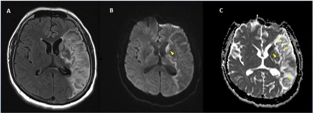 Figure 1. Stroke seen in a 41-year-old male patient with COVID-19 infection.