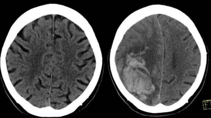 Figure 1. The left image shows the initial CT scan of the brain in a patient on both clopidogrel (Plavix) and aspirin who presented to the Emergency Department with head trauma that did not demonstrate any intracranial hemorrhage. The right image shows a head CT obtained 24 hours later demonstrating a large parenchymal hemorrhage in the right.