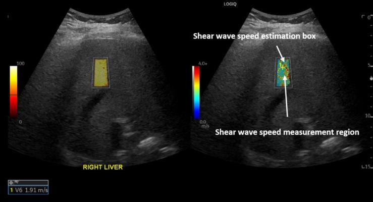 Figure 1. A 55-year-old female with a history of COVID-19 infection 38 weeks before the date of ultrasound shear wave elastography. The shear wave speed of 1.91 m/s corresponds to Young’s modulus of 10.94 kPa which indicates abnormally high liver stiffness and may reflect chronic liver injury.