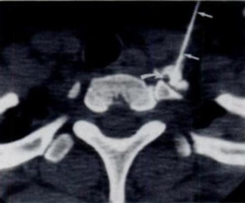  CT-guided stellate ganglion injection. (Courtesy of Radiology)