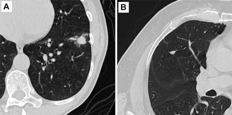 Figure 2. Axial CT images of pulmonary nodules. (A) Malignant nodule. (B) Benign nodule.