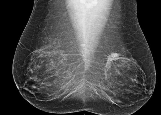 Mammography Screening Intervals May Affect Breast Cancer Prognosis