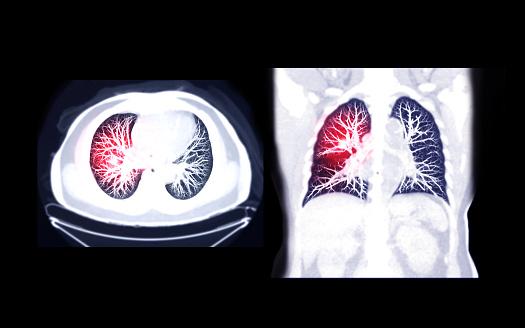 Research finds that a commonly used risk-prediction model for lung cancer does not accurately identify high-risk Black patients who could benefit from early screening