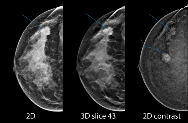 digital breast tomosynthesis, DBT, synthesized 2-D mammography, S2D, screening recall rates, Radiology journal study