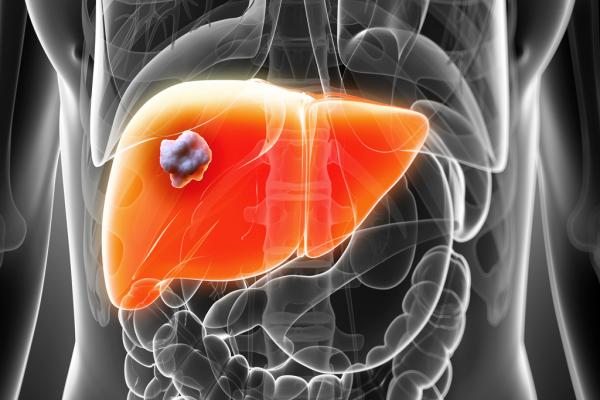 The research collaboration agreement covers a joint clinical retrospective study on liver fibrosis severity in Non-Alcoholic Steato-Hepatitis (NASH) patients