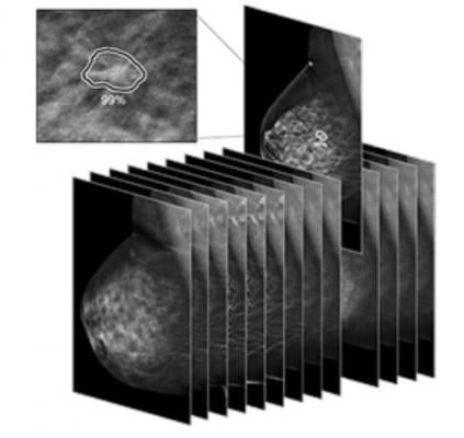  iCad announced that ProFound AI Version 3.0 for Digital Breast Tomosynthesis (DBT) was cleared by the U.S. Food and Drug Administration (FDA).