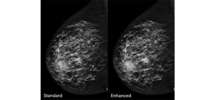 concurrent-read cancer detection solution for digital breast tomosynthesis 