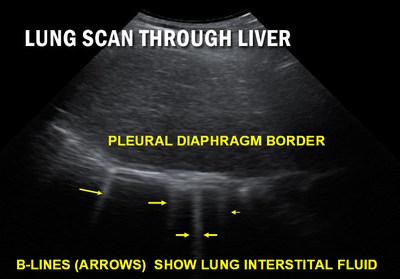 #COVID19 #Coronavirus #2019nCoV #Wuhanvirus #SARScov2 Sonogram taken under rib cage shows liver (grey) with curved diaphragm-lung border (white). Arrows point to vertical B lines (white) demonstrating diseased lung tissue. The more B lines the worse the disease. Healing is measured by reduction in the number of B lines.