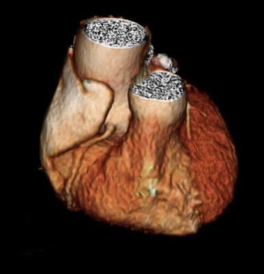 CT Shows Enlarged Aortas in Former Pro Football Players