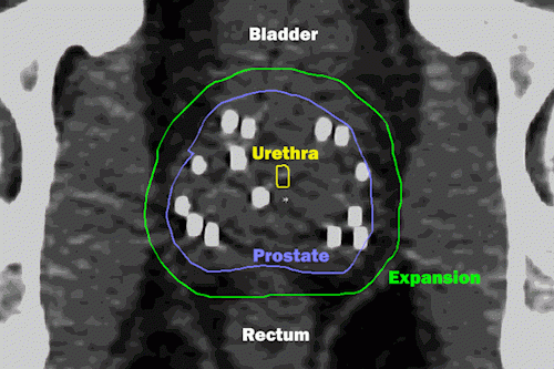 MRI, prostate cancer, radiation therapy, vessel sparing, quality of life