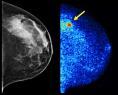 Molecular Imaging to Improve Cancer Detection in Dense Breasts