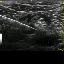 musculoskeletal, MSK, ultrasound, Soundwaves, Florida