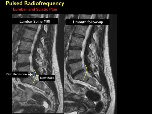 Minimally Invasive Treatment Provides Relief from Back Pain