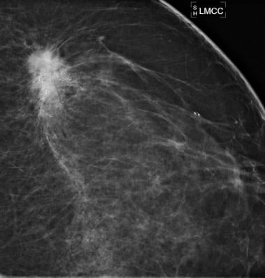 Navidea, Lymphoseek injection, breast cancer detction, scintigraphy, SNMMI 2016