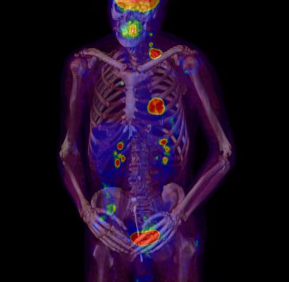 ASTRO guideline, bone metastases, pallliative radiation therapy, gold standard