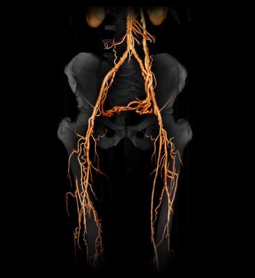 ACR, American College of Radiology, MEDCAC, peripheral arterial disease, PAD, seniors