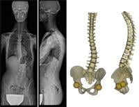 sterEOS 1.5 Orthopedic Imaging X-Ray EOS Imaging 