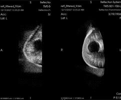 3-D Whole Breast Ultrasound