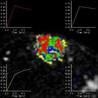 Kinetic Variable Useful for Identifying Malignant MRI-Detected Breast Lesions
