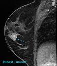 MRI Technique Means Fewer Breast Biopsies in High-Risk Women