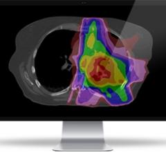 Radiation Treatment Quality and Time Savings Highlight Mirada Medical Software
