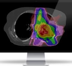 Radiation Treatment Quality and Time Savings Highlight Mirada Medical Software