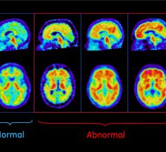 Plaques in Brain Scans Forecast Cognitive Impairment