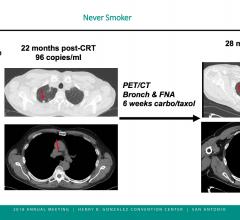 Biomarker blood test accurately confirms remission in non-smoker with HPV-associated oral cancer. ASTRO 2018 #ASTRO2018 #ASTRO #ASTRO18