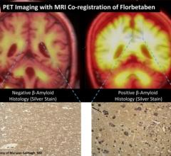 Alzheimer's Disease Clinical Trial/Study PET Systems MRI 
