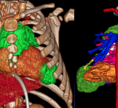 3D CT image reconstruction of the thoracic organs and the heart using Philips software.