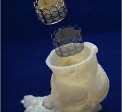 3-D printing, aortic valve model, aortic stenosis, Cleveland Clinic, ASE 2016