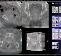 low-risk prostate cancer, active surveillance, ASCO recommendations