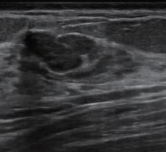 Computer‐Aided Diagnosis Improves Breast Ultrasound Expertise in Multicenter Study