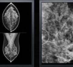 VuComp, M-Vu CAD, digital breast tomosynthesis, DBT