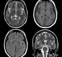 MRI Shows Brain Differences Among ADHD Patients