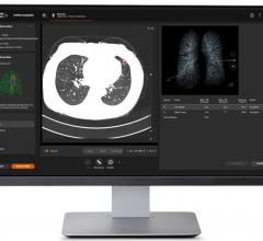 During the virtual 106th Scientific Assembly and Annual Meeting of the Radiological Society of North America (RSNA), Nov. 29 to Dec. 5, Siemens Healthineers announced the Food and Drug Administration (FDA) clearance of AI-Rad Companion Organs RT, the latest Siemens Healthineers artificial intelligence-based software assistant in the AI-Rad Companion family. 