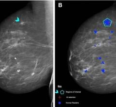 Using a standardized assessment, researchers in the UK compared the performance of a commercially available artificial intelligence (AI) algorithm with human readers of screening mammograms. 