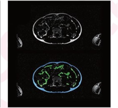 Automated abdominal adipose tissue segmentation into SAT, VAT via Dixon MRI in different children 