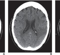 Mobile devices proved both reliable and accurate for the clinical decision to administer IV thrombolysis in patients with acute stroke