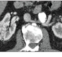 a 5-tiered CT scoring algorithm may represent a clinically useful tool for diagnosis of clear-cell renal cell carcinoma (RCC) in small (≤4 cm) solid renal masses. 