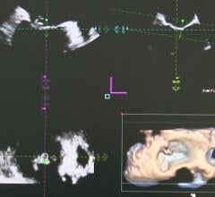 ASE Participating in Global Study to Establish New Standardization in Cardiovascular Ultrasound