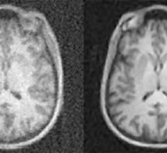 Artificial Intelligence Provides Faster, Clearer MRI Scans