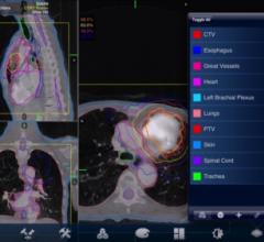 Accuray Rolls Out PlanTouch for the CyberKnife System