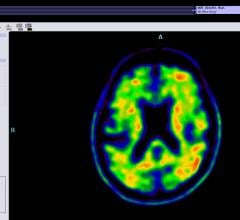 Alzheimer's Association, IDEAS Study, website, participation, brain PET scan