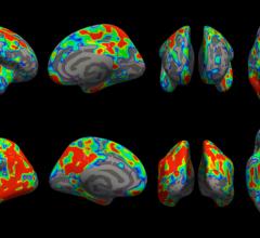 Colored areas of the brain represent regions where the loss of brain synapses in people with early-stage Alzheimer’s was greater than people with normal cognitive function.